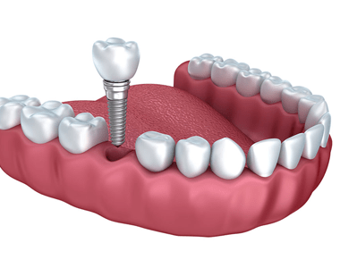 Will Dental Implants really help you? Let’s see what the Clinical results say?- treatment at Martinsville Family Dentistry  