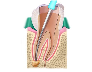 Root Canals: FAQs about treatment that can save your Tooth- treatment at Martinsville Family Dentistry  