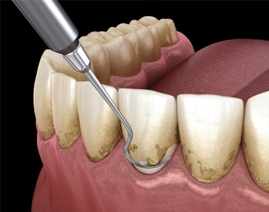 Everything you Need to Know About Scaling and Root Planing- treatment at Martinsville Family Dentistry  