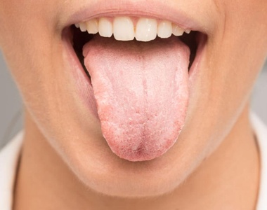 Dry Mouth – Facts and Tips- treatment at Martinsville Family Dentistry  