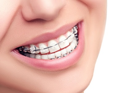 What To Know Before Getting Braces- treatment at Martinsville Family Dentistry  