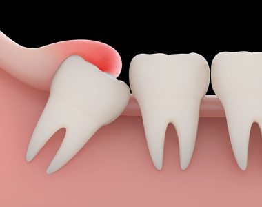 Problems with a Wisdom tooth and when you need to remove them- treatment at Martinsville Family Dentistry  