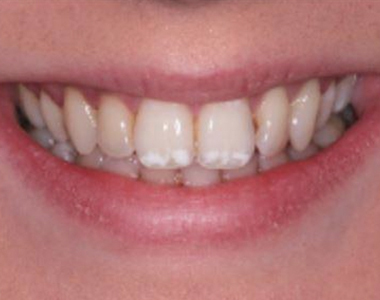 What You Need to Know About Fluorosis- treatment at Martinsville Family Dentistry  