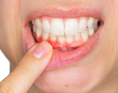 What Causes Receding Gums?- treatment at Martinsville Family Dentistry  