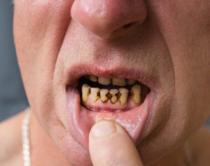 Meth Mouth How Methamphetamine Use Affects Dental Health Martinsville