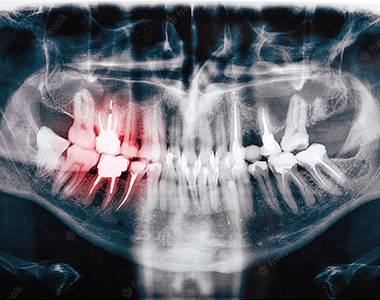 Dental x-ray- treatment at Martinsville Family Dentistry  