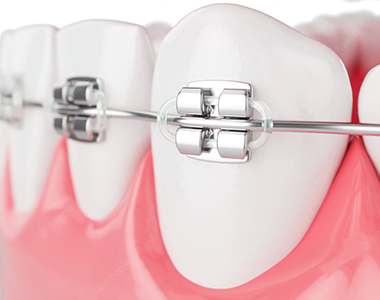 Braces- treatment at Martinsville Family Dentistry  