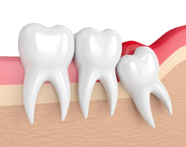 Wisdom Teeth- treatment at Martinsville Family Dentistry  