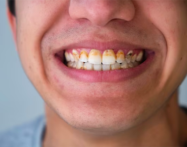 The Devastating Effects of Methamphetamine Use on Dental Health- treatment at Martinsville Family Dentistry  