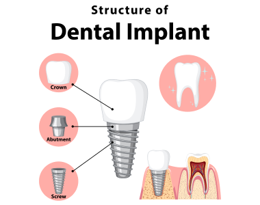 Your Guide to Dental Implants: Restoring Smiles in Martinsville, VA- treatment at Martinsville Family Dentistry  
